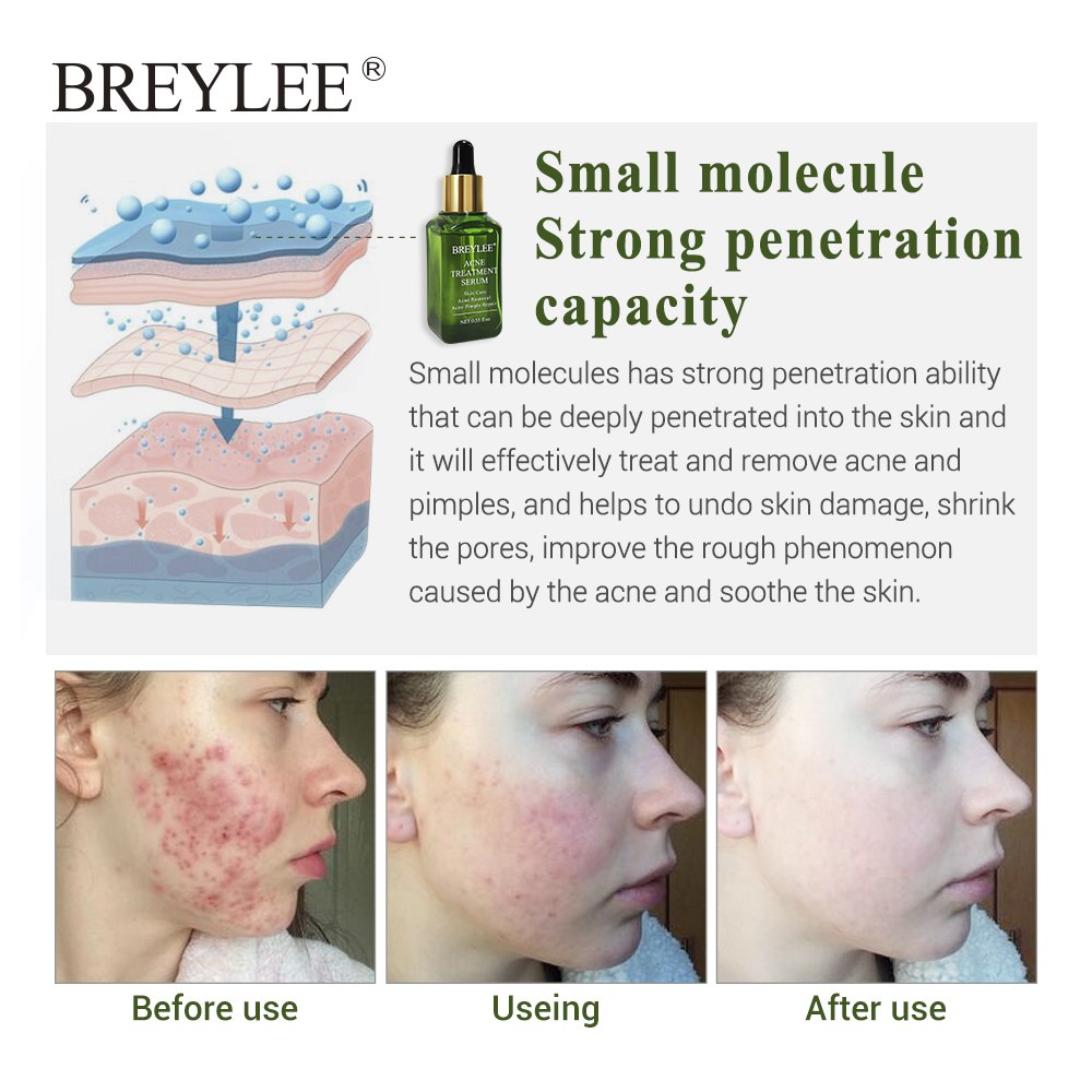 BREYLEE Acne Treatment Serum Face Facial Anti Acne Scar Removal Cream Skin Care Whitening Repair Pimple Remover For Acne