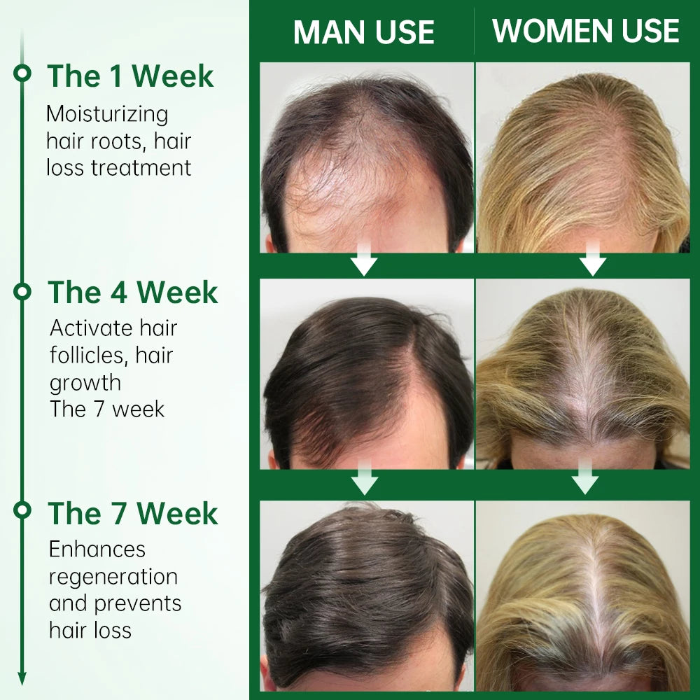 Rosemary Anti Hair Loss Hair Growth Oil