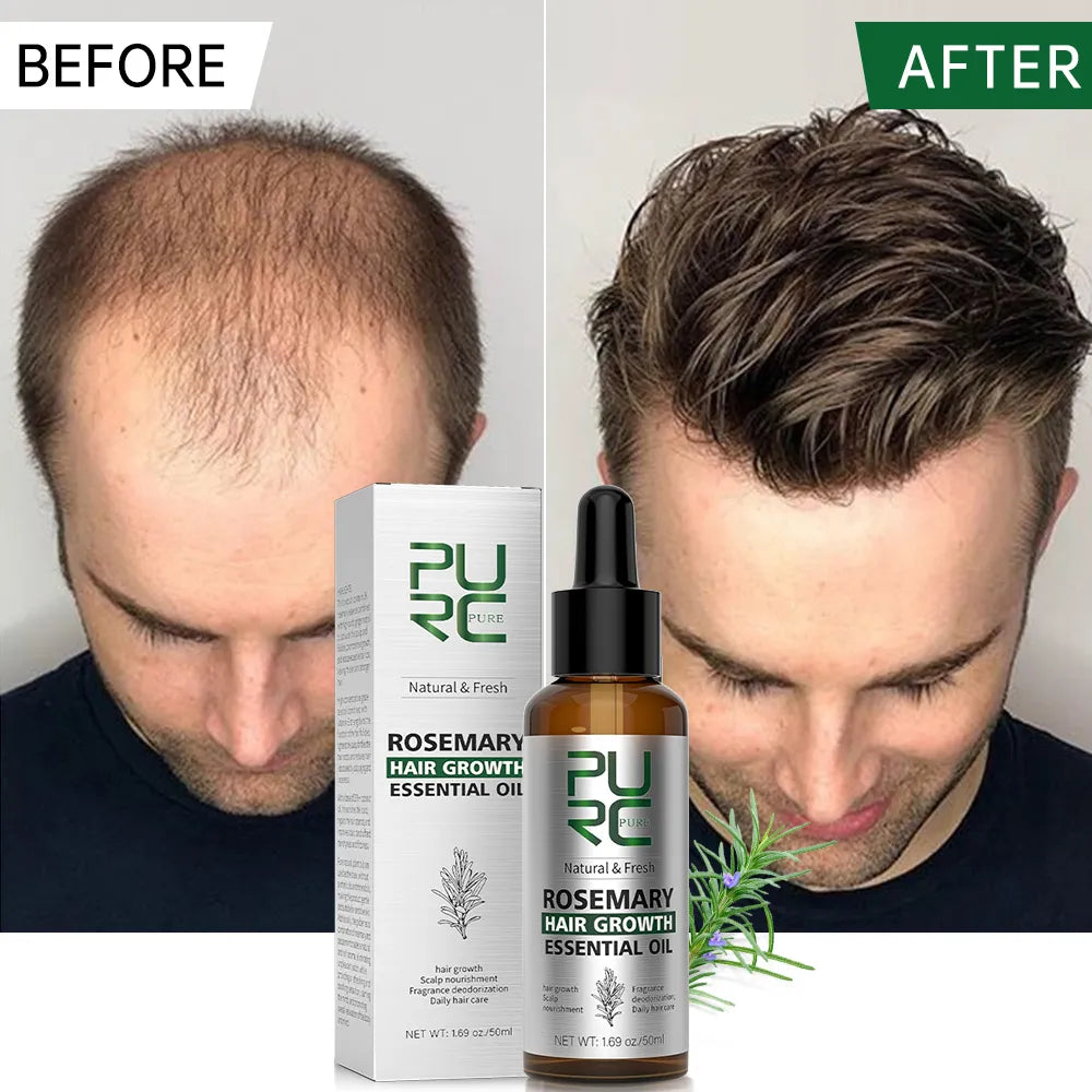 Rosemary Anti Hair Loss Hair Growth Oil